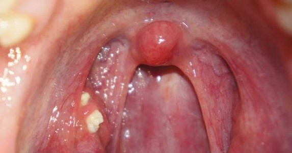 Amigdalitis caseosa