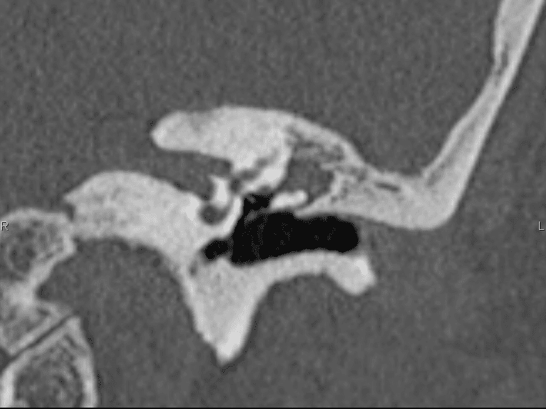 Imagen de TAC de oído izquierdo, con colesteatoma