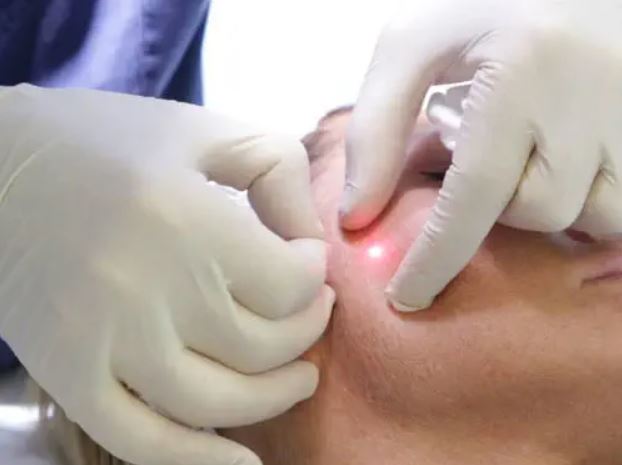 aplicación laser endolift altiorem