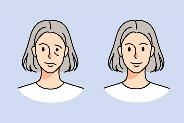 Síntomas de la parálisis Facial